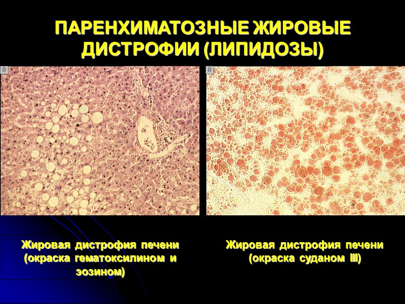 ПАРЕНХИМАТОЗНЫЕ БЕЛКОВЫЕ ДИСТРОФИИ Гидропическая дистрофия Характеризуется появлением в клетке вакуолей, наполненных цитоплазматической жидкостью. Жидкость