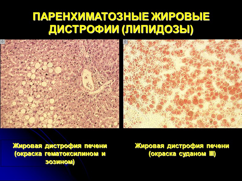 Виды дистрофии рисунки