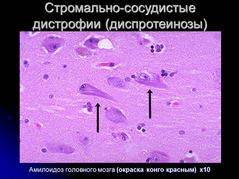 Стромально-сосудистые дистрофии (диспротеинозы)  Предшественником АА-белка амилоид­ных фибрилл является α - глобулин, названный сывороточным