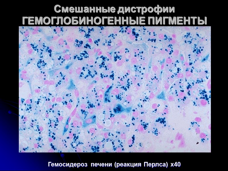 Смешанные дистрофии ГЕМОГЛОБИНОГЕННЫЕ ПИГМЕНТЫ  Местный гемосидероз. Развивается при внесосудистом гемолизе в очагах кровоизлияний.