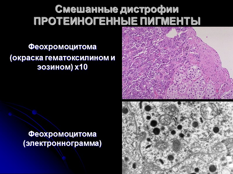 Презентация смешанные дистрофии