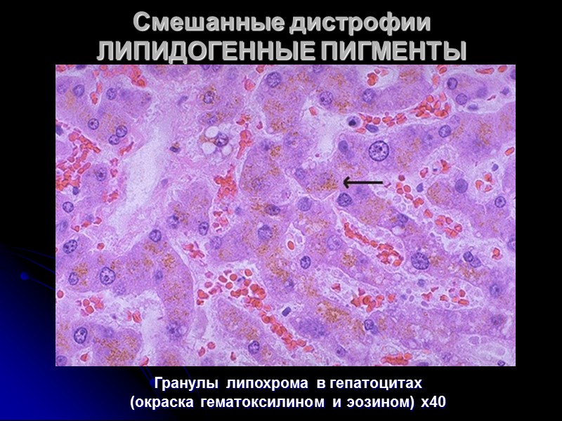 Смешанные дистрофии  ЛИПИДОГЕННЫЕ ПИГМЕНТЫ  Липохромы (лютеины) — пигменты, окрашивающие в желтый цвет