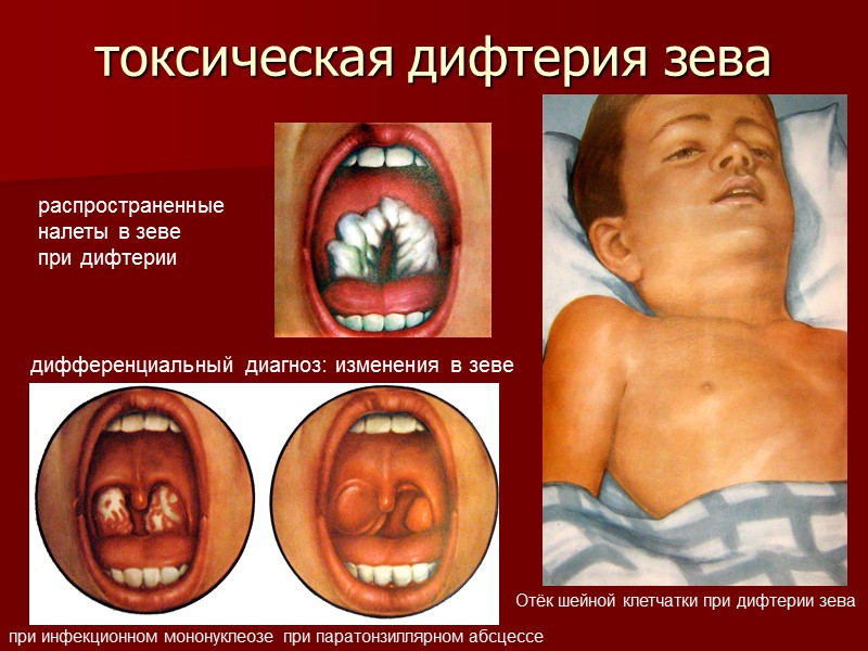 Дифтерия  (Diphtheria) – тяжелое инфекционное заболевание  От греческого    