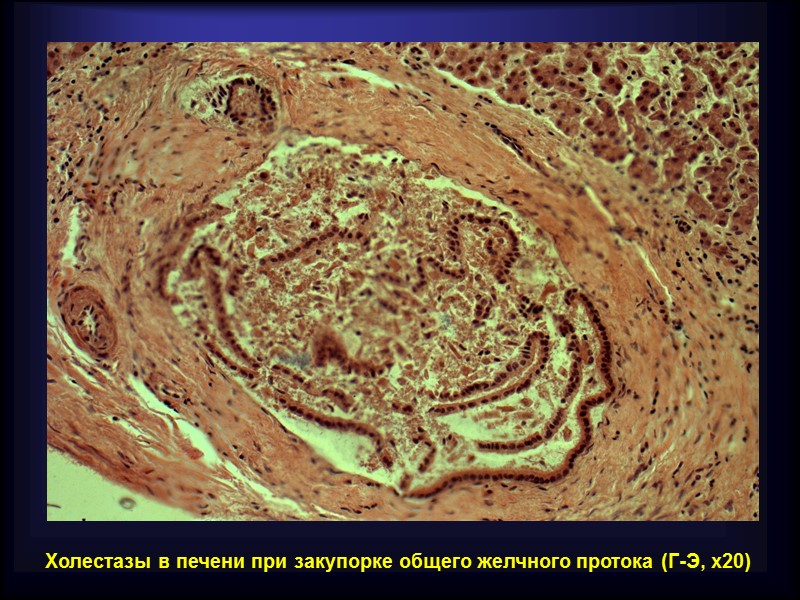 Звенья обмена билирубина в организме человека  1. Распад гемоглобина в клетках ретикуло-макрофагальной системы
