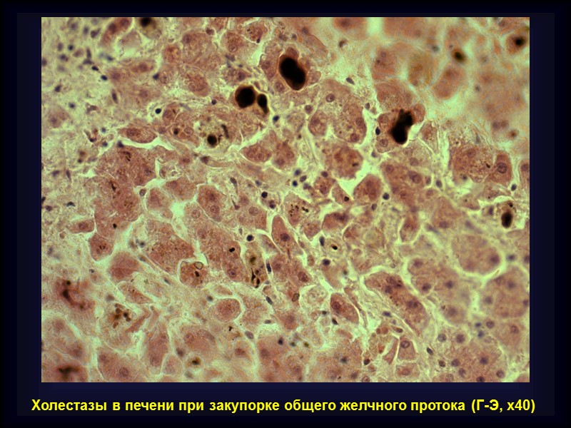 Печёночная (паренхиматозная) желтуха Развивается в результате неадекватного захвата, конъюгации или экскреции билирубина гепатоцитами. 