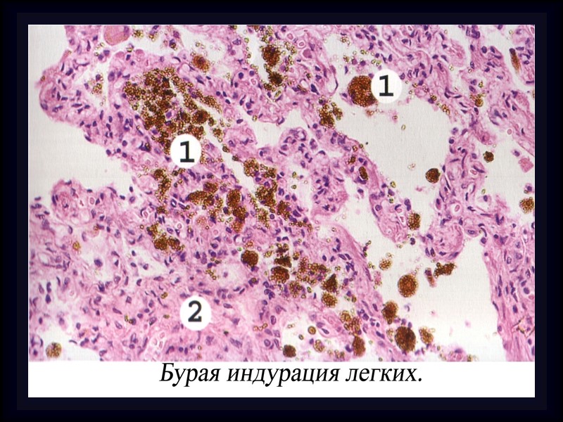 Классификация гемоглобиногенных пигментов