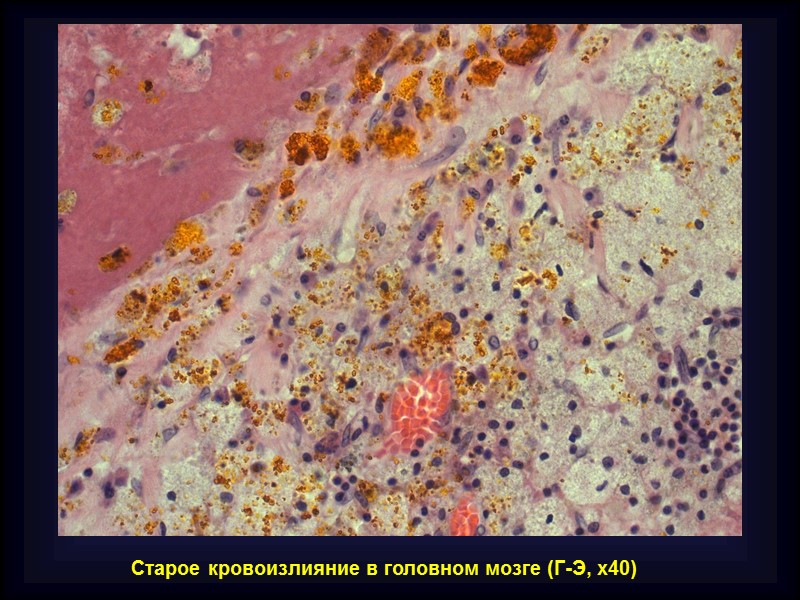 Осложнения уролитиаза Обструкция мочевых путей – гидронефроз Острый и хронический пиелонефрит, цистит