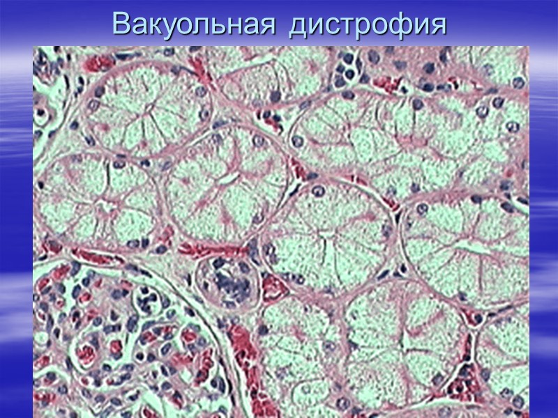 Гиалиново-капельная дистрофия Характеризуется появлением и накоплением в цитоплазме клеток эозинофильных (окрашивающихся в розовый цвет)