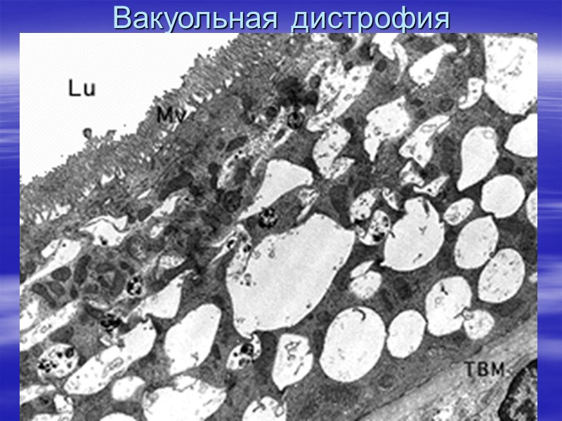 Гиалиново-капельная дистрофия