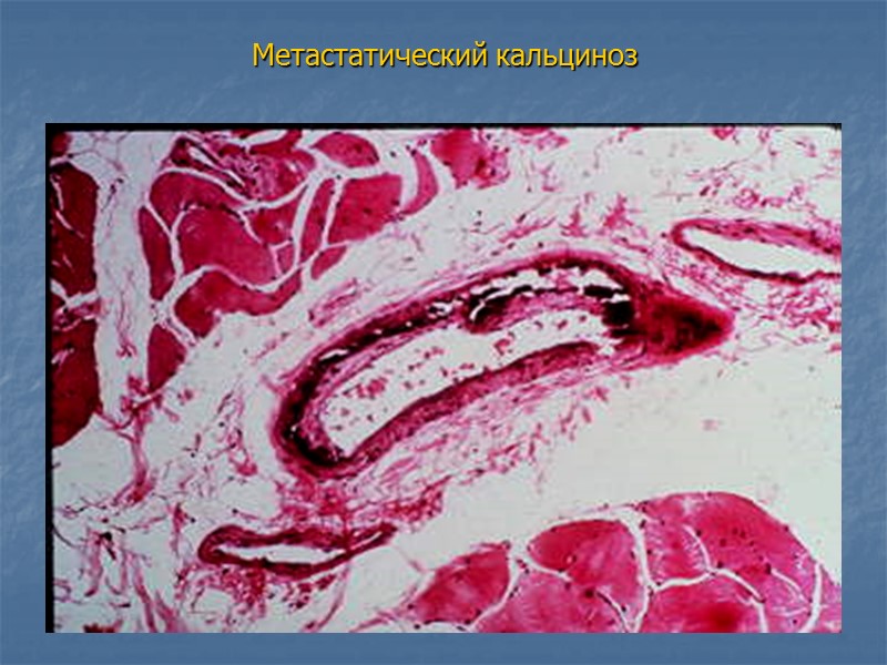 Липофусцин в гепатоцитах