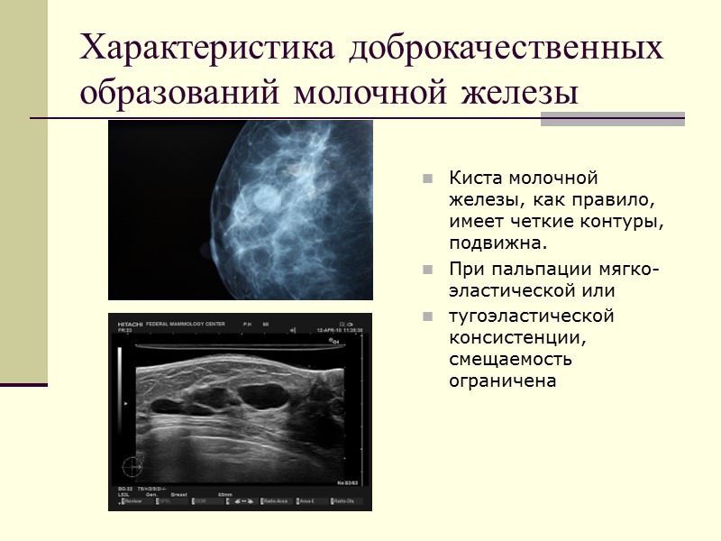 Ультразвуковая картина доброкачественных опухолей молочной железы тесты нмо ответы