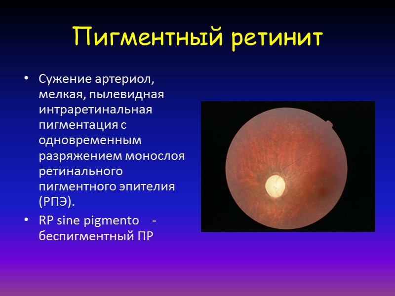 Воспаление сетчатки. Пигментный ретинит глазное дно. Тапеторетинальная дистрофия сетчатки. Симптомы пигментной дегенерации сетчатки. Тапеторетинальная абиотрофия сетчатки.