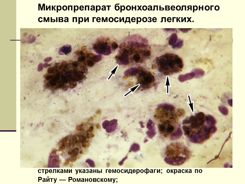 Гемоглобиногенные пигменты Встречаются в норме:   Гемосидерин Ферритин Билирубин  Образуются в условиях