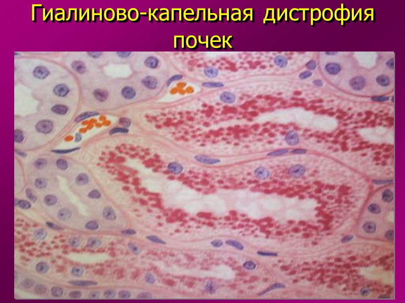Обратимые повреждения клеток.  Внутриклеточные накопления (паренхиматозные дистрофии).