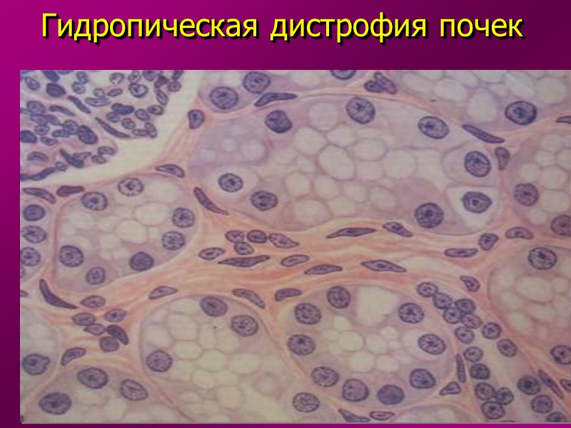 «Зернистая» дистрофия: Локализация: гепатоциты, кардиомиоциты, эпителий извитых канальцев почки; Причины: инфекции, интоксикации, неполноценное питание,