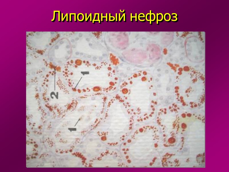Жировая дистрофия печени (окраска судан III)