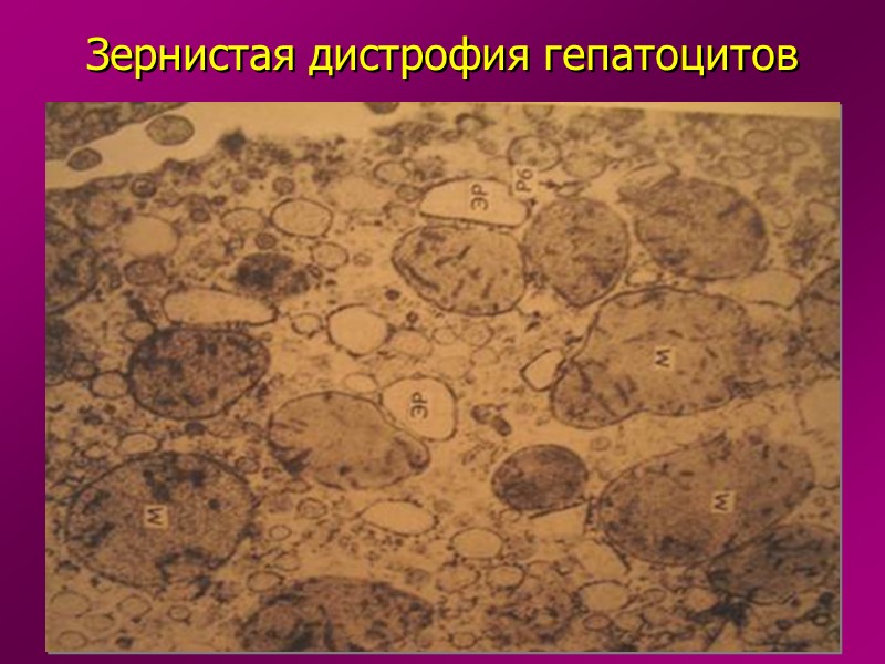 Морфология дистрофий: Изменение макроскопической картины (форма, размеры, консистенция, цвет) Изменение микроскопической картины (при помощи