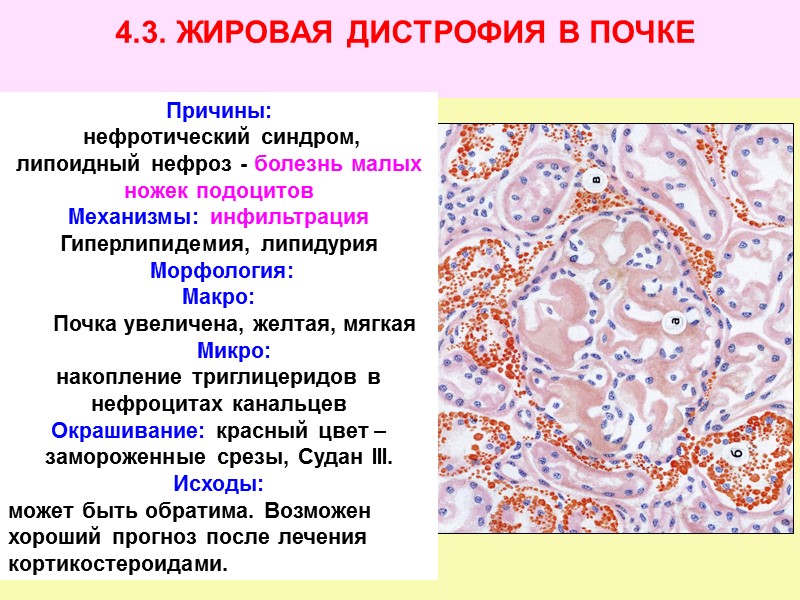 4.1) Стеатоз печени = жировая дистрофия = гусиная печень 4.2) «Тигровое сердце»  4.3)