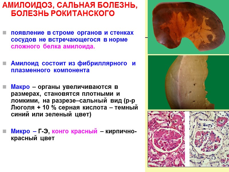 КЛАССИФИКАЦИЯ  ГИАЛИНОЗА   1. ГИАЛИНОЗ СОСУДОВ Общий: гипертоническая болезнь, сахарный диабет (диабетическая