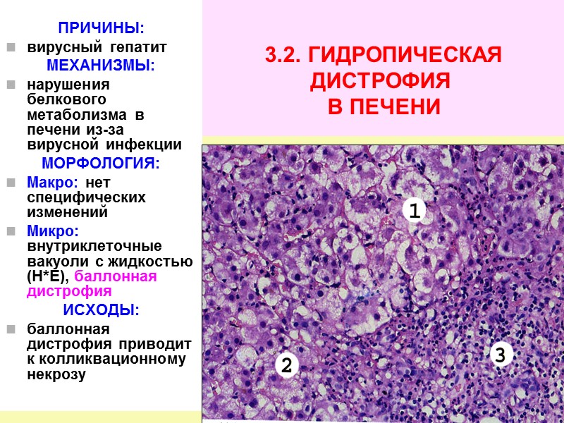 Признаки дистрофии печени