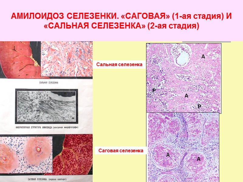 Амилоидоз клинические рекомендации. Саговая селезенка патологическая анатомия препарат. Амилоидоз селезенки патанатомия. Амилоидоз кишечника микропрепарат. САГОВЫЙ амилоидоз селезенки.