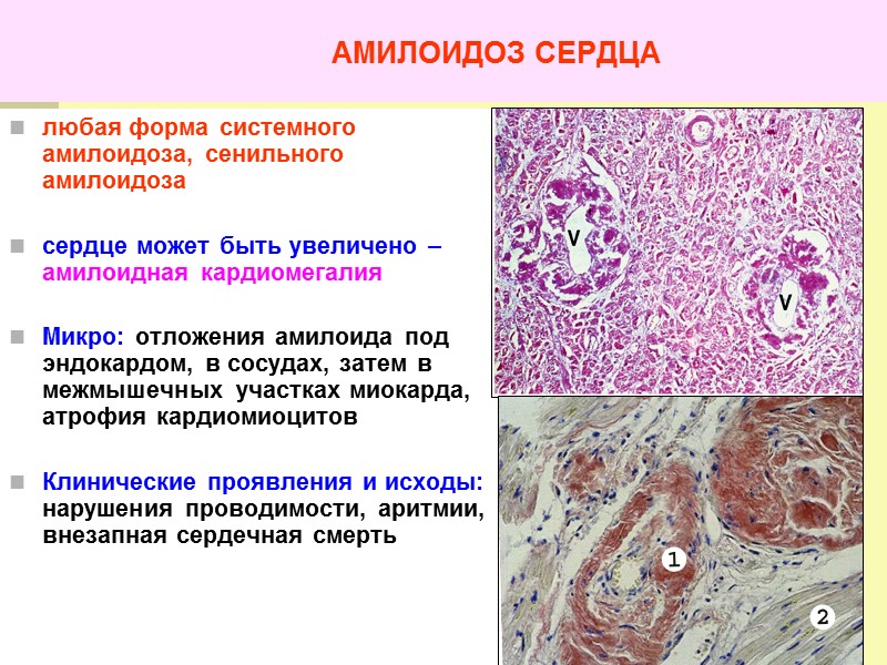 АМИЛОИДОЗ СЕЛЕЗЕНКИ. «САГОВАЯ» (1-ая стадия) И «САЛЬНАЯ СЕЛЕЗЕНКА» (2-ая стадия) Сальная селезенка Саговая селезенка