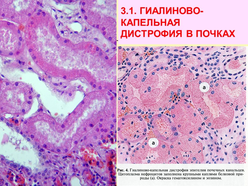 9. СТРОМАЛЬНО-СОСУДИСТЫЕ УГЛЕВОДНЫЕ ДИСТРОФИИ          