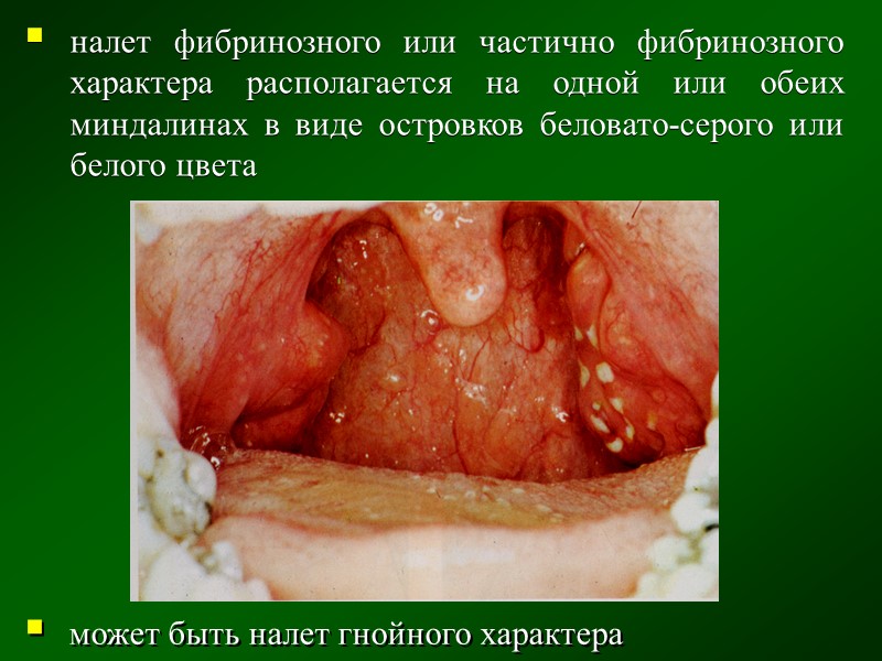 По локализации: а)   дифтерия миндалин  б)   дифтерия носа 
