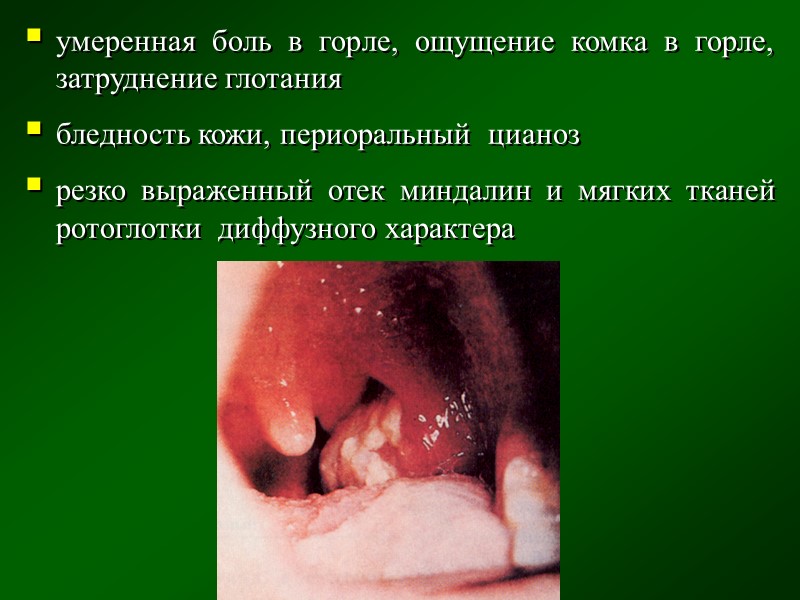 ДИАГНОСТИЧЕСКИЕ  КРИТЕРИИ (клинические, лабораторные)  Клинические: клинические проявления зависят от клинической формы дифтерии