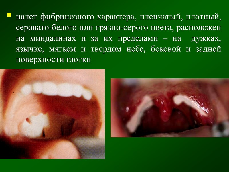 Дифтерия миндалин легкой степени тяжести: острое начало головная боль, слабость, вялость температура тела нормальная