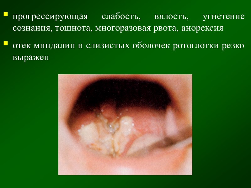 налет пленчатый, фибринозного характера, плотный, блестящий, сероватого цвета на одной или обеих миндалинах в