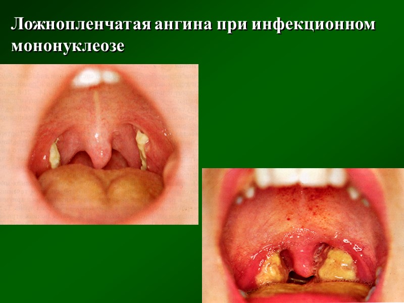 Дифтерия у детей фото горла