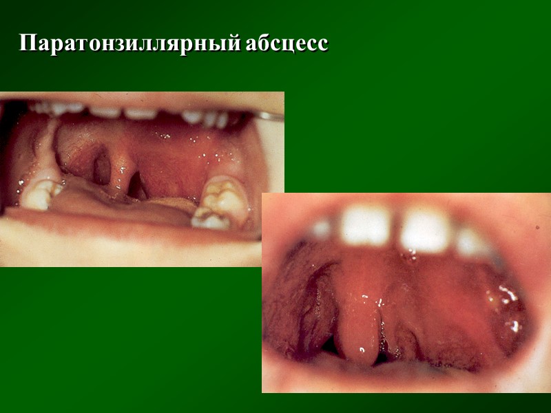ДИФФЕРЕНЦИАЛЬНЫЙ ДИАГНОЗ   Локализованная и распространенная форма дифтерии миндалин:   Острая фолликулярная
