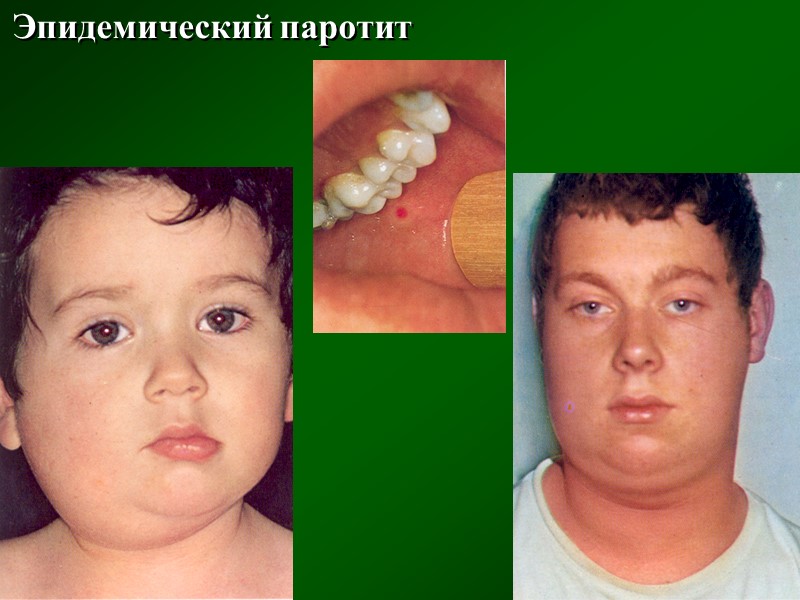 Ложнопленчатая ангина при инфекционном мононуклеозе