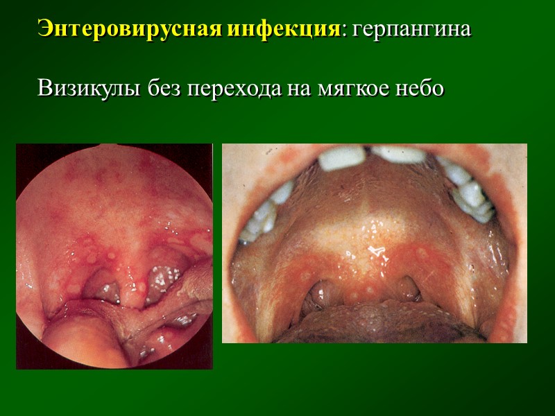 Паратонзиллярный абсцесс