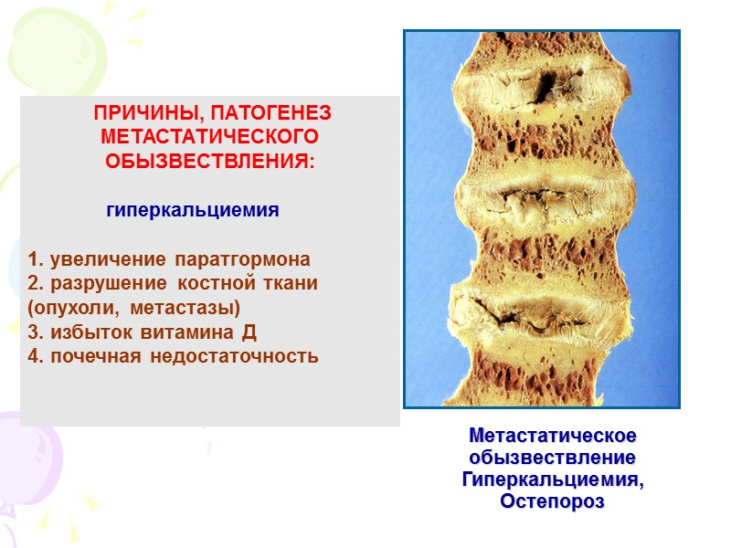 ПОДАГРИЧЕСКИЙ  АРТРИТ, ТОФУСЫ          Выпадение