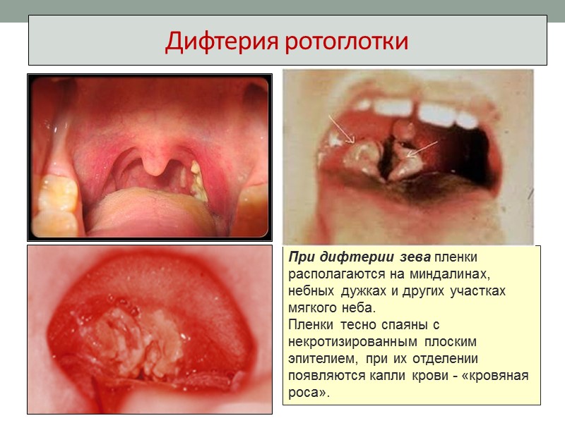 Факторы патогенности Пили и микрокапсула обеспечивают адгезию к эпителиоцитам миндалин, реже гортани, трахеи, полости