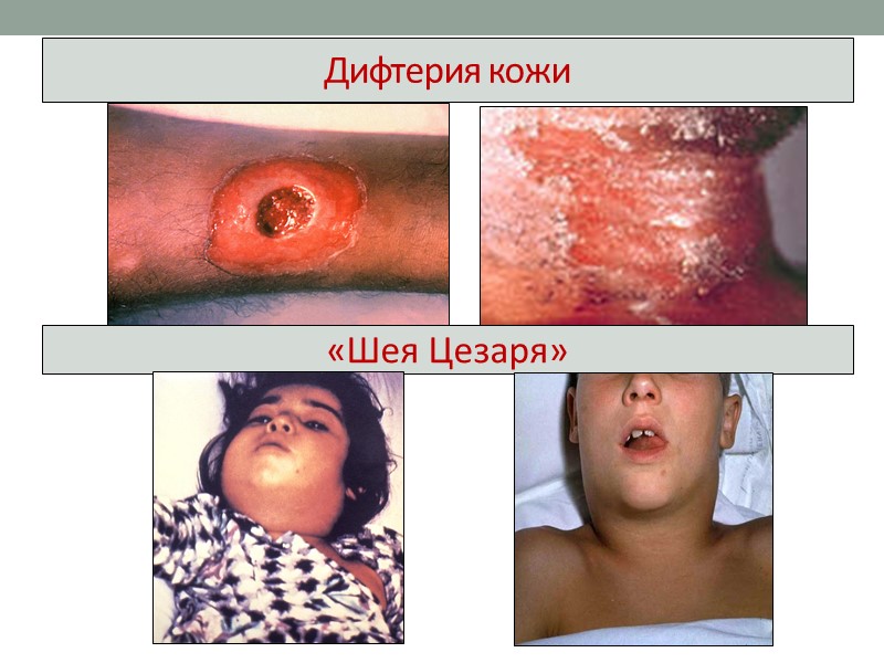 Гиалуронидаза, нейраминидаза, коллагеназа, гемолизин – факторы инвазии;   микрокапсула – антифагоцитарный фактор; 