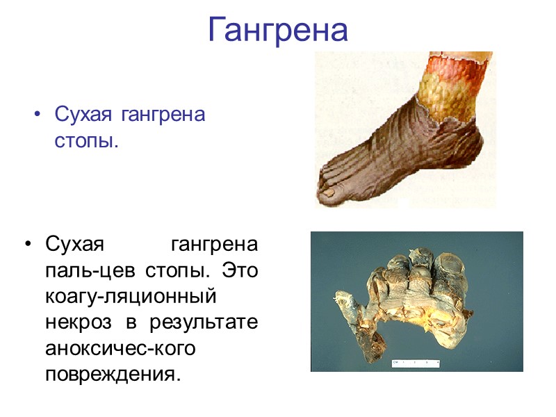 Гангрена нижней конечности карта вызова скорой помощи