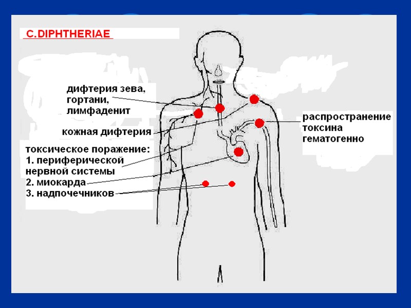 Патогенез дифтерии схема