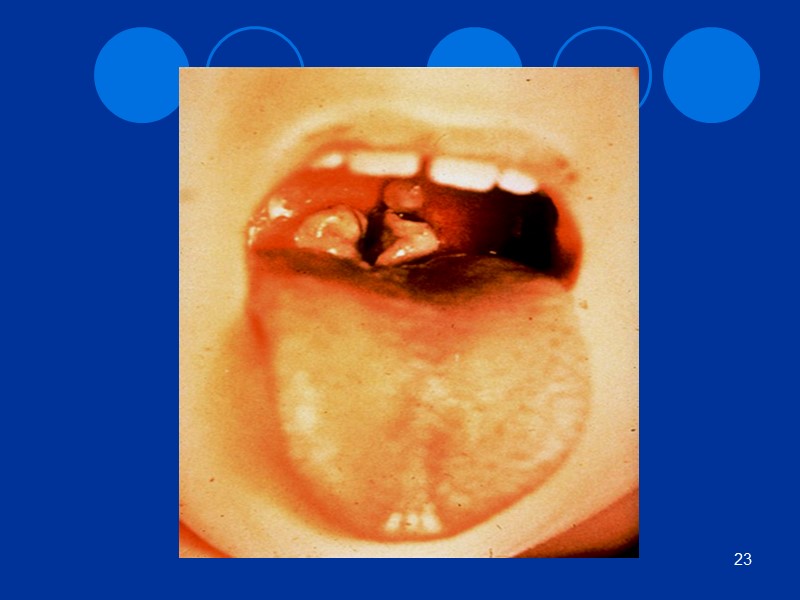 Принципы профилактики дифтерии Специфическая Вакцинопрофилактика детям от 3 мес. до 18 лет взрослым –