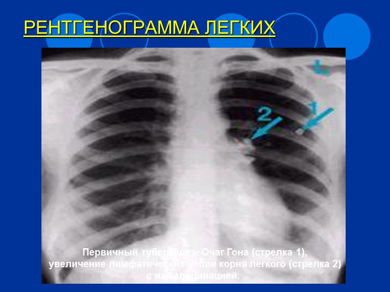 Патогенетические эффекты возбудителя Подавление фагоцитарной реакции (незавершенный фагоцитоз в макрофагах) Образование гранулемы В центре