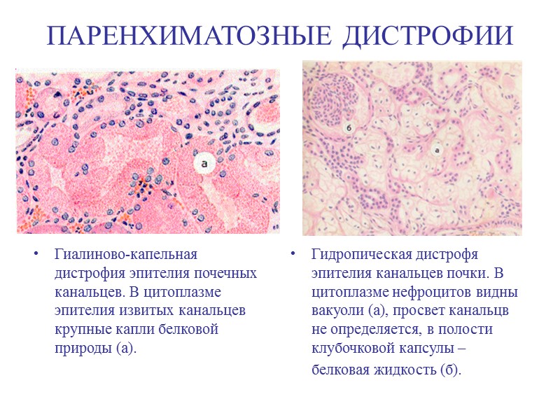 ПАРЕНХИМАТОЗНЫЕ ДИСТРОФИИ (липидозы) Жировая дистрофия эпителия почечных канальцев (при амилоидозе почек). В капиллярных петлях