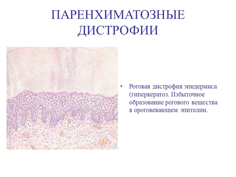 ПАРЕНХИМАТОЗНЫЕ ДИСТРОФИИ Клетка коры головного мозга при ганглиозидлипидозе (болезнь Тея-Сакса). В цитоплазме большое количество