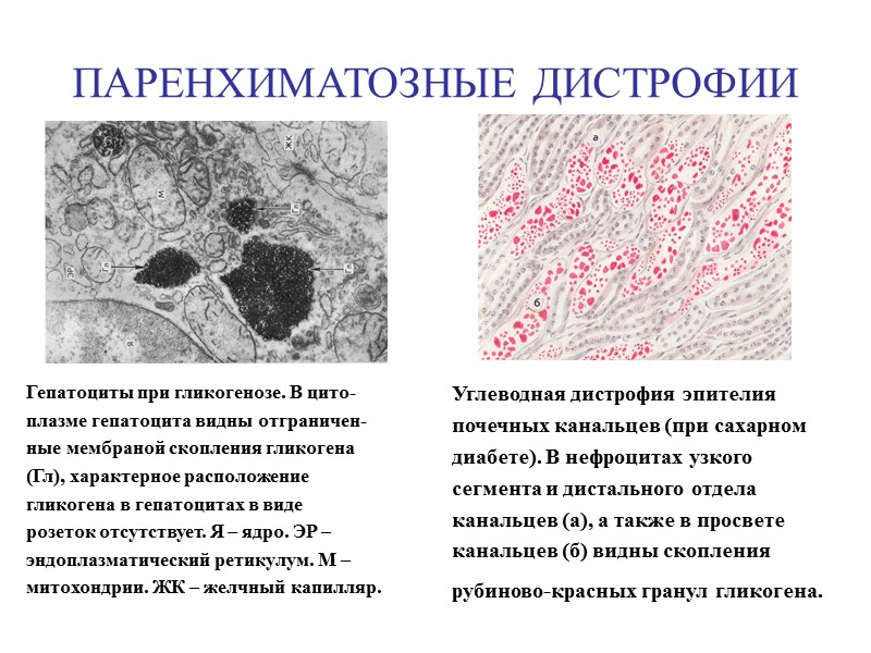 Паренхиматозные белковые дистрофии Паренхиматозные диспротеинозы морфологически представлены:  1.гиалиново-капельной  2.гидропической дистрофией 3.роговой дистрофией