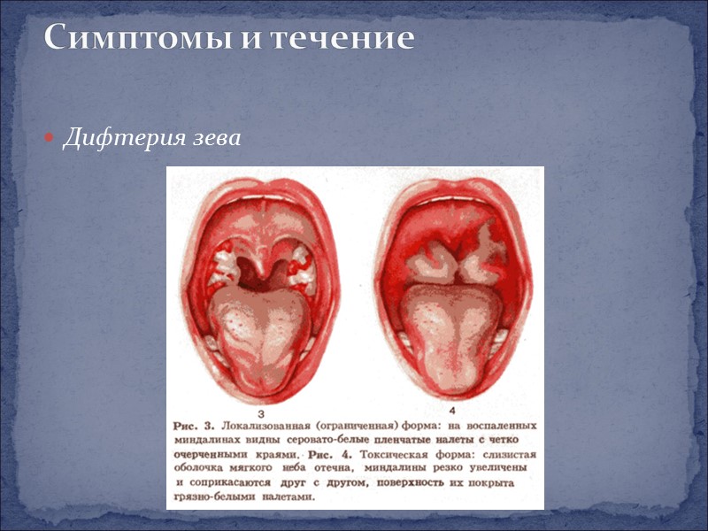 Дифтерия зева Симптомы и течение