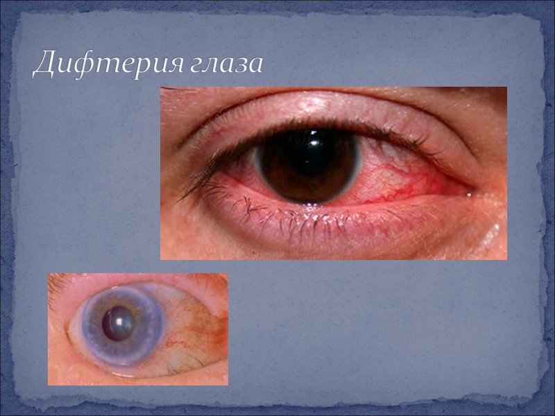 Дифтерия глаза