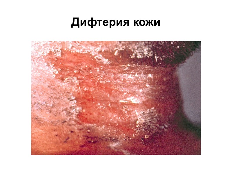 Клиническая картина(5) При геморрагической форме налеты пропитываются кровью, кровоизлияния на коже, кровотечение из носа,