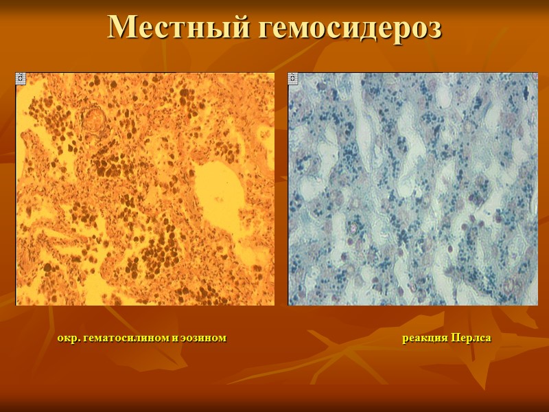 Гемоглобиногенные пигменты, образующиеся:   В физиологических условиях:  при патологии:  ферритин 