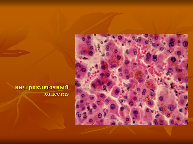 Нарушения обмена гемоглобиногенных пигментов 1. Гемохроматоз 2. Гемосидероз (общий и местный)   